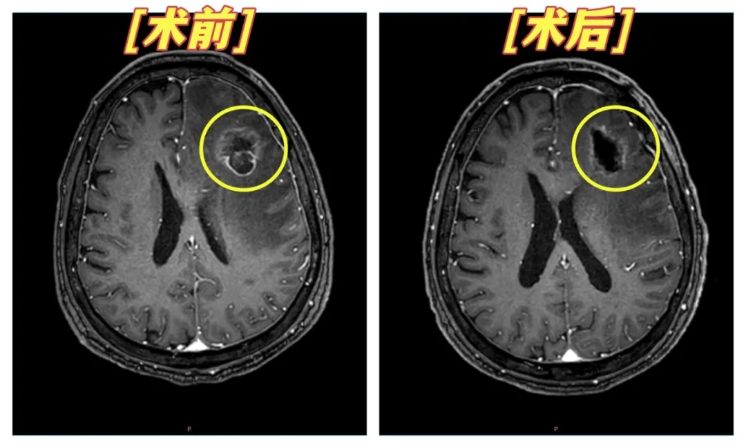 Post-operative recovery — Mr. Xie regaining mobility and speech after precision neurosurgery at Chongqing HYGEIA Hospital